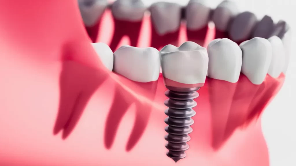 implant illustration