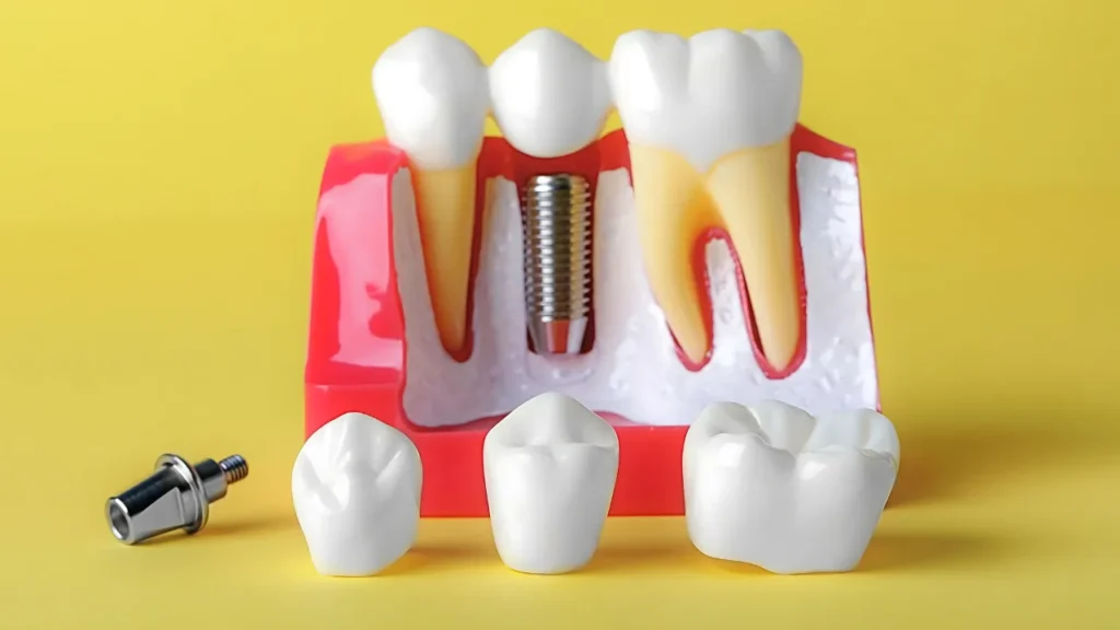 Dental Crowns Cost in Pretoria | Affordable Solutions