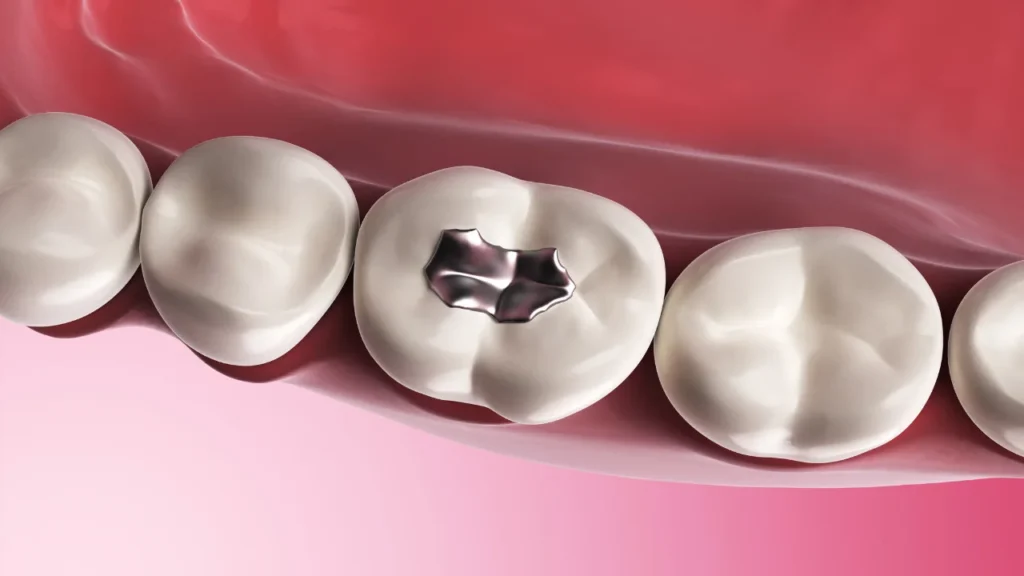 Fillings Teeth Cost in Pretoria | A Comprehensive Guide