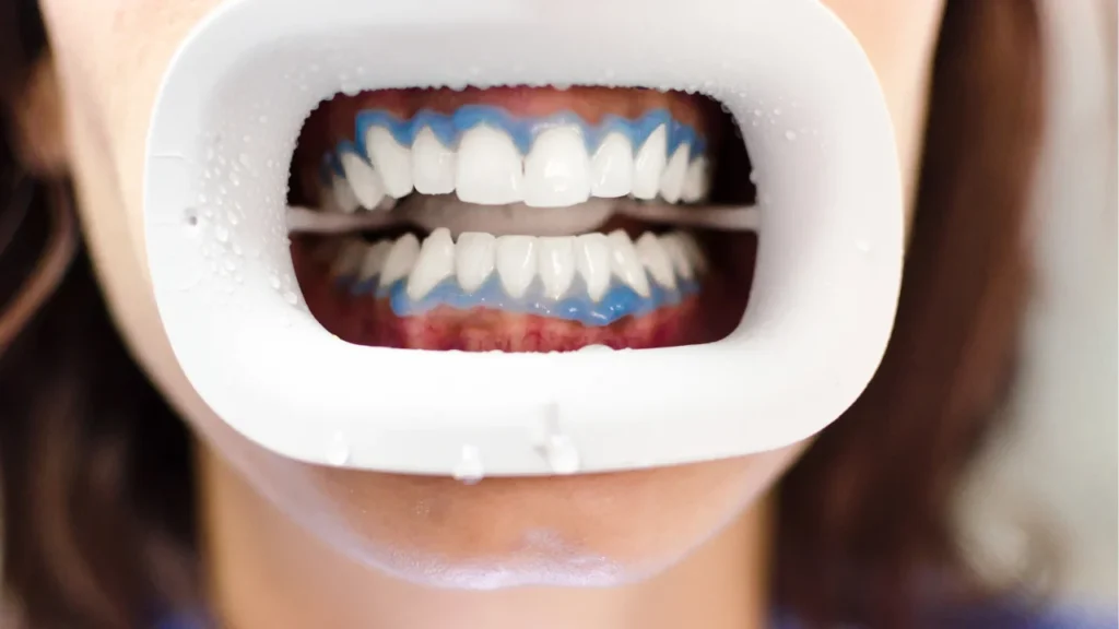 Teeth Whitening Price in Pretoria | Affordable Costs
