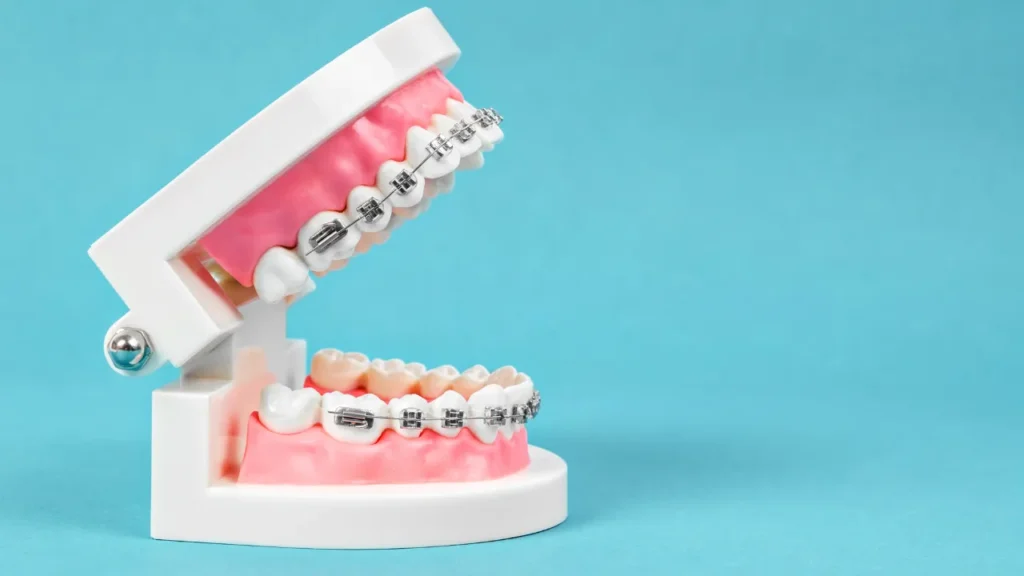 Invisalign or Traditional Braces | Best Choice For Your Smile